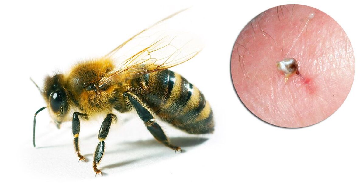 Hondrostrong sadrži pčelinji otrov koji poboljšava metaboličke procese u tkivima